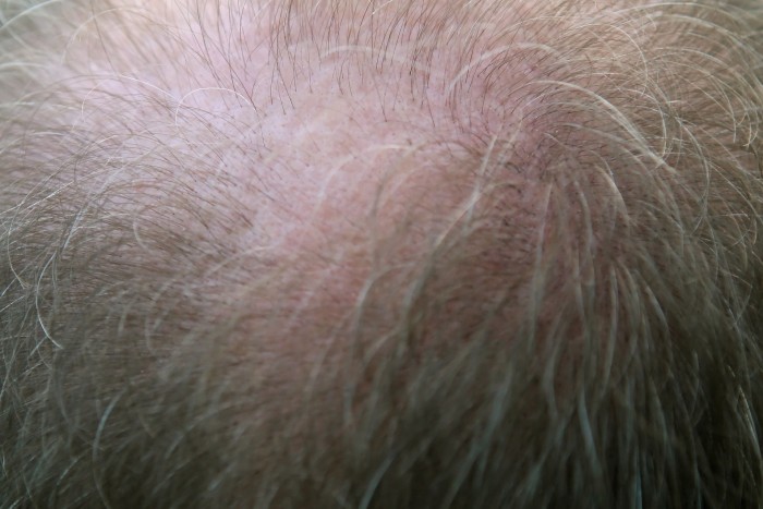 How to choose the right hair replacement system for thinning or balding hair loss...